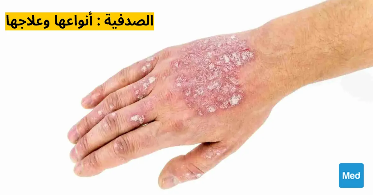 الصدفية : أنواعها وعلاجها